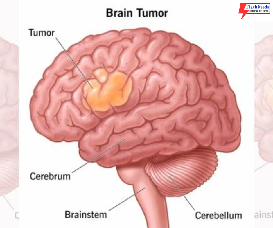 24k yearly deaths linked to brain tumors